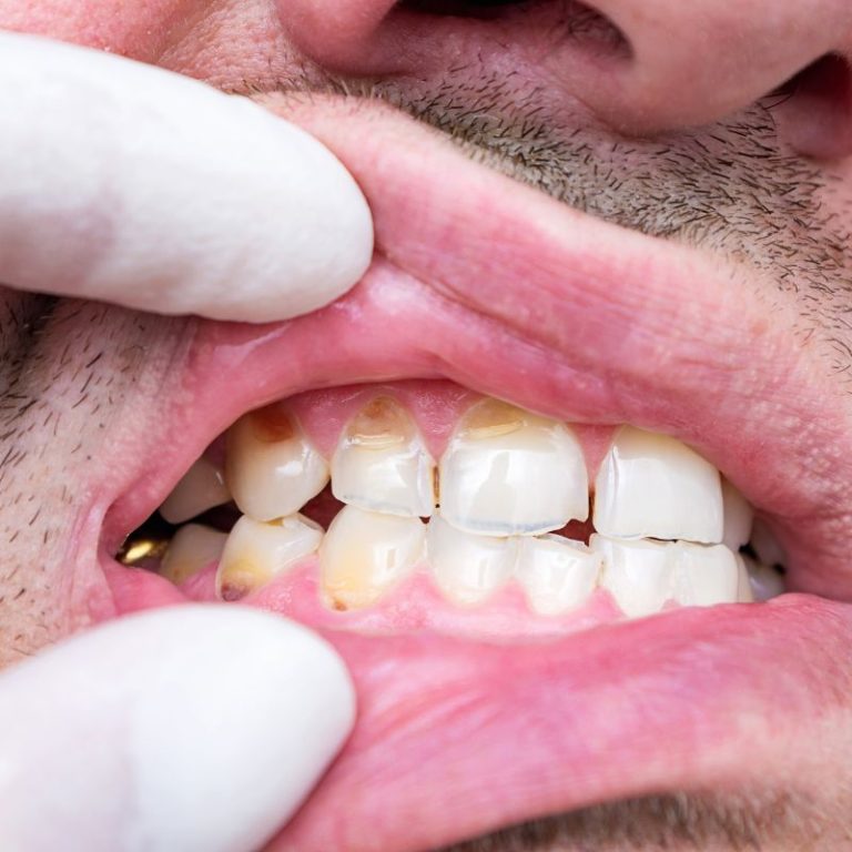 hipoplasia del esmalte
